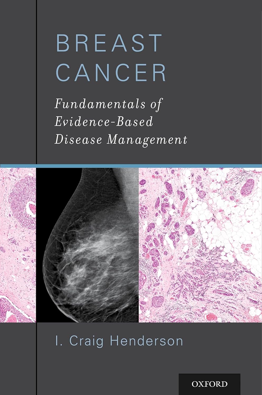 BREAST CANCER FUNDAMENTALS OF EVIDENCE BASED DISEASE MANAGEMENT 1ST/2015  - CRAIG HENDERSON