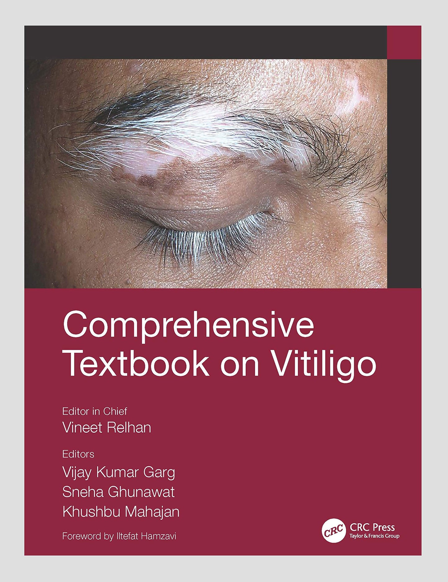 COMPREHENSIVE TEXTBOOK OF VITILIGO 1ST/2021 VINEET RELHAN (selected chapters)
