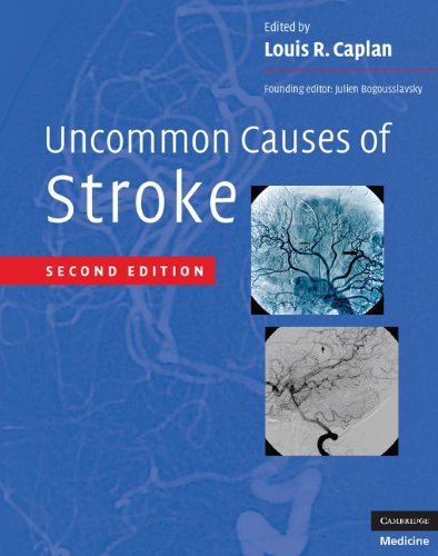UNCOMMON CAUSES OF STROKE 2ND/2008 - LOUIS CAPLAN