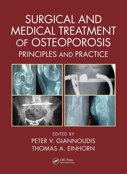 SURGICAL AND MEDICAL TREATMENT OF OSTEOPOROSIS: PRINCIPLES AND PRACTICE 1ST/2020-PETER GIANNOUDIS