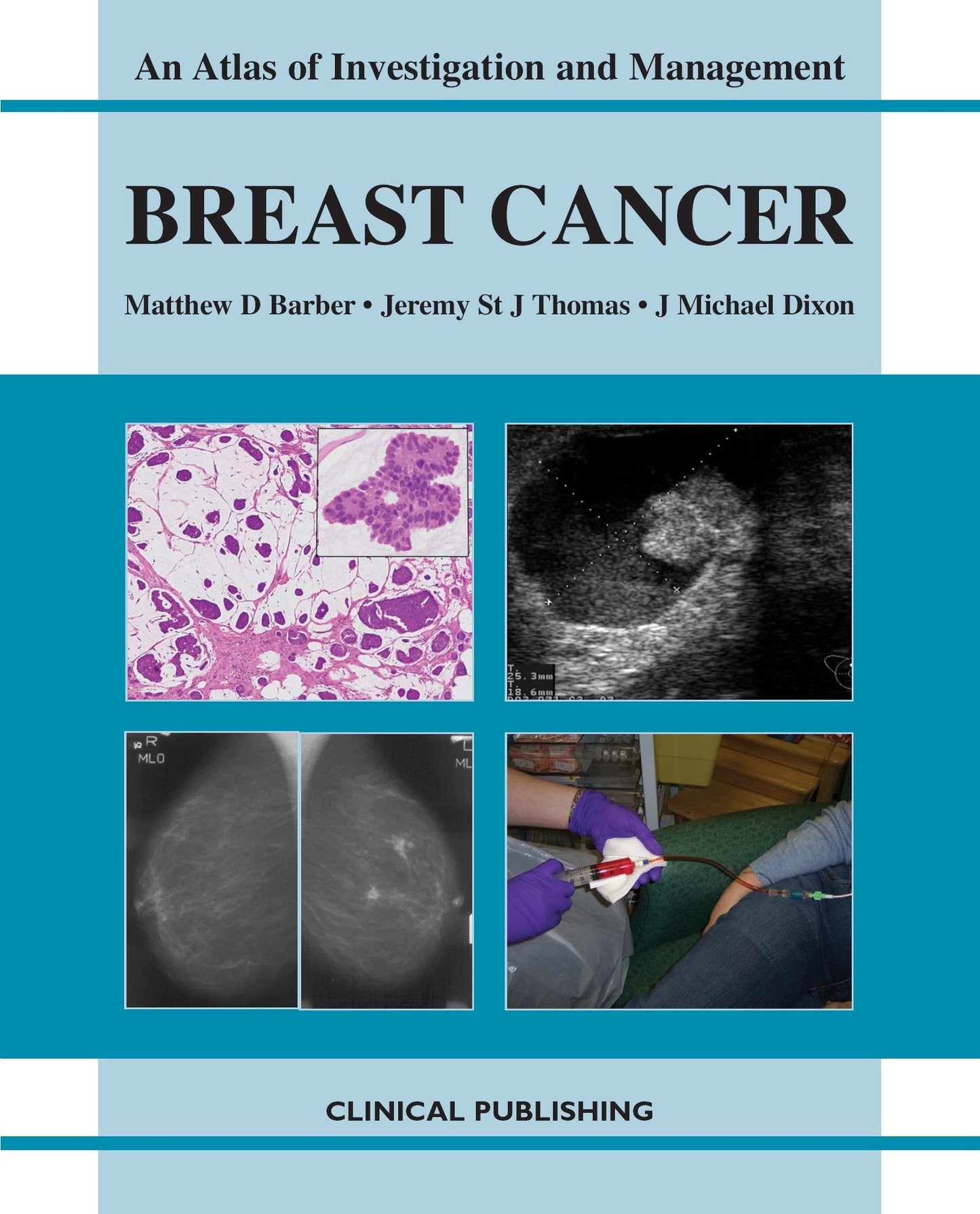 AN ATLAS OF INVESTIGATION AND MANAGEMENT BREAST CANCER 1ST/2008 - MATTHEW BARBER