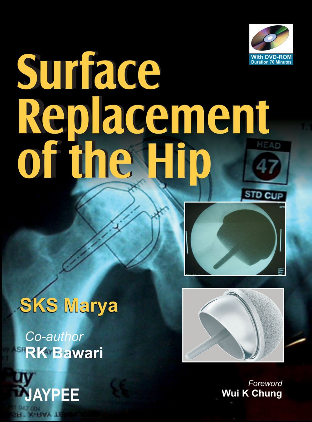 SURFACE REPLACEMENT OF THE HIP 1ST/2007 - SKS MARYA (DVD NOT AVAILABLE)