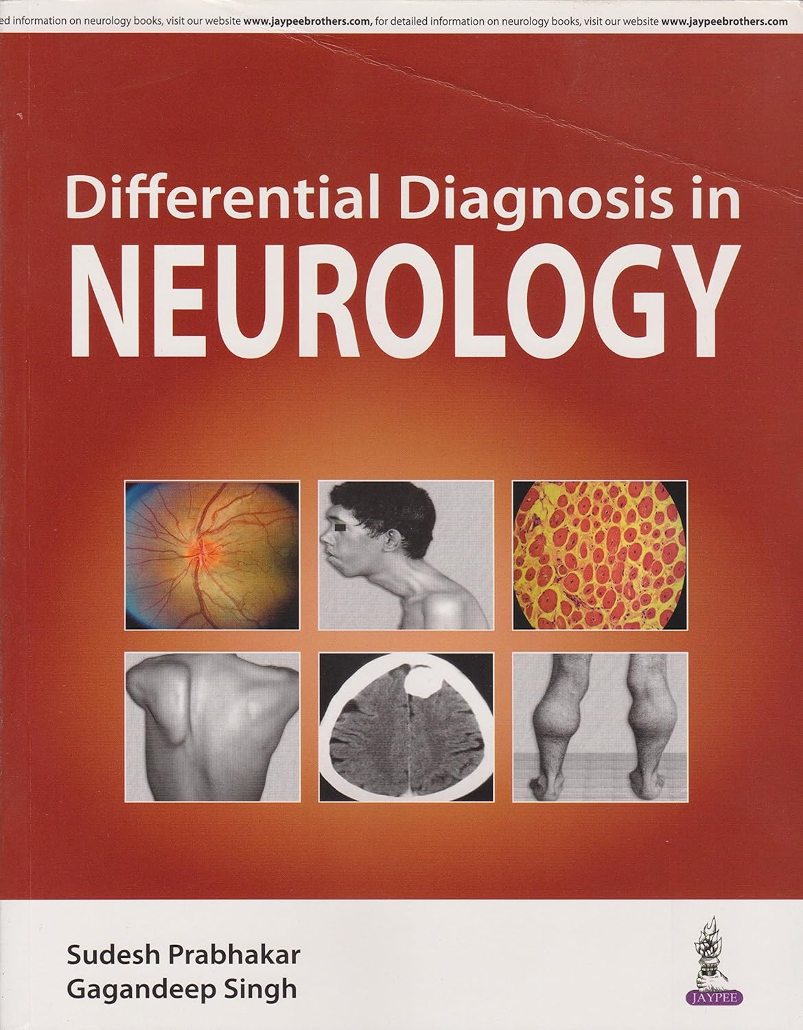 DIFFERENTIAL DIAGNOSIS IN NEUROLOGY 1ST/2016  - SUDESH PRABHAKAR