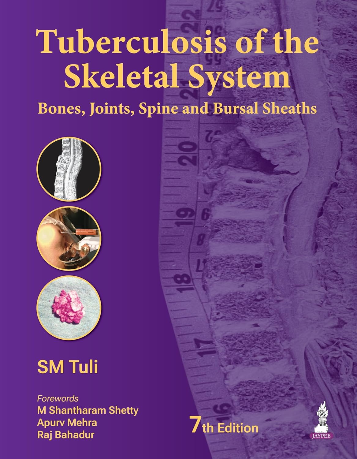 TUBERCULOSIS OF THE SKELETAL SYSTEM (BONES, JOINTS, SPINE AND BURSAL SHEATHS) 7TH/2026 - SM TULI