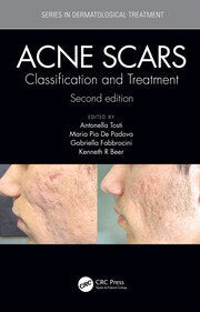 ACNE SCARS CLASSIFICATION AND TREATMENT 2E/2019