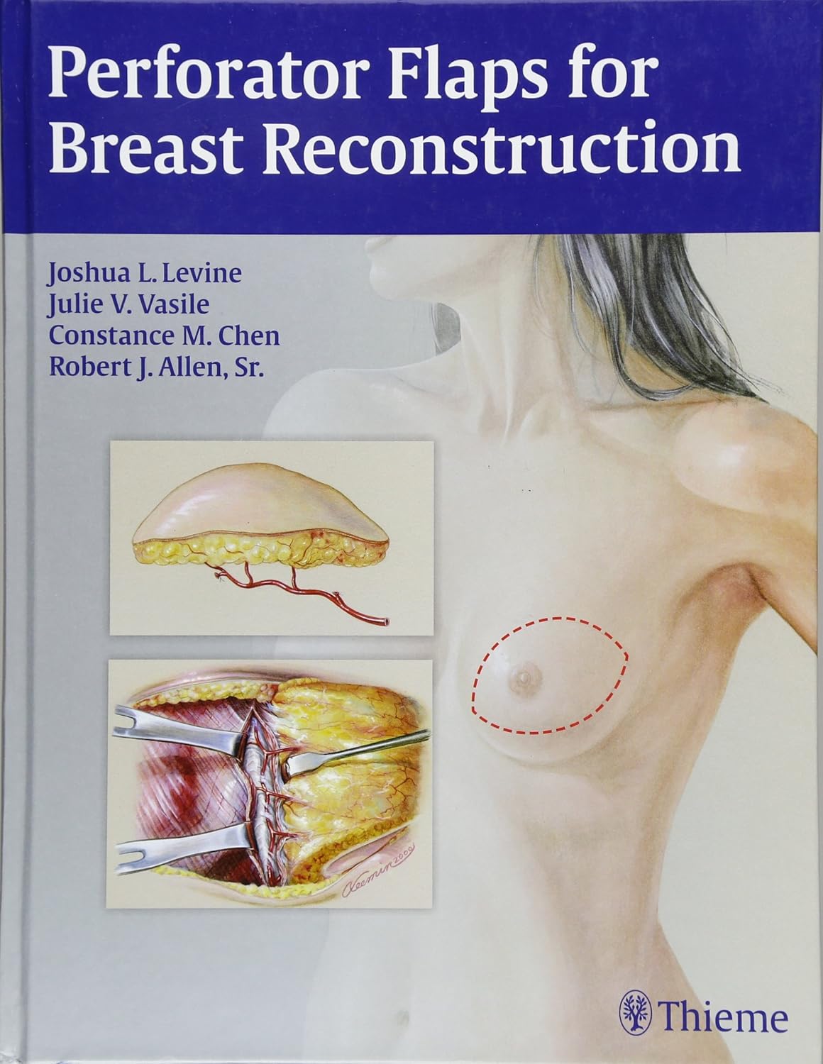 PERFORATOR FLAPS FOR BREAST RECONSTRUCTION 1E/2016