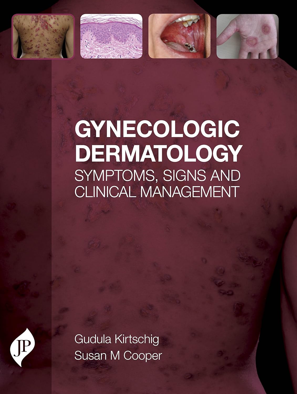 GYNECOLOGIC DERMATOLOGY SYMPTOMS, SIGNS AND CLINICAL MANAGEMENT 1ST/2016 - GUDULA KIRTSCHING