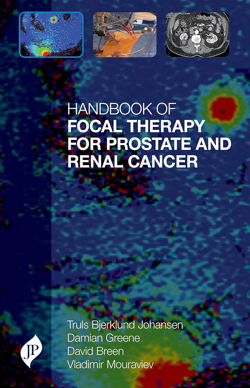 HANDBOOK OF FOCAL THERAPY FOR PROSTATE AND RENAL CANCER 1ST/2017 - TRULS E BJERKLUND JOHANSEN