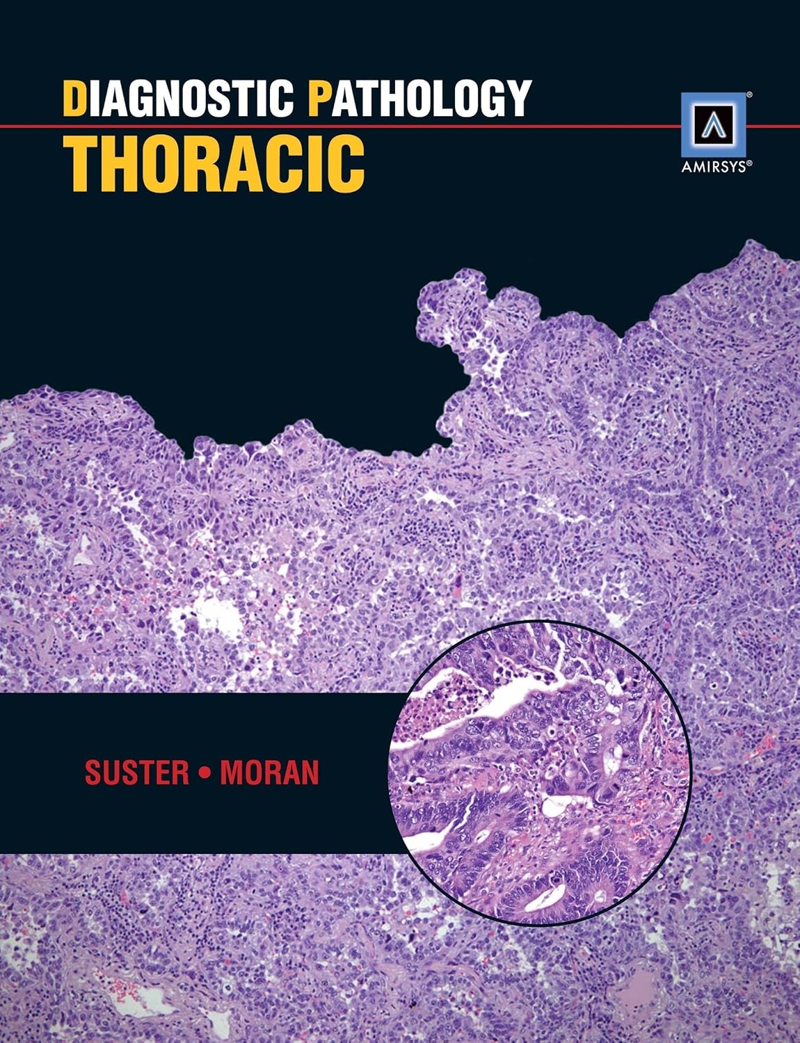 DIAGNOSTIC PATHOLOGY THORACIC 1ST/2012 - SUSTER,MORAN