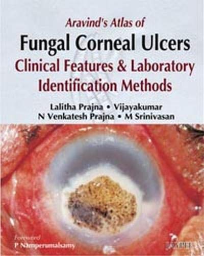 ARAVIND'S ATLAS OF FUNGAL CORNEAL ULCERS CLINICAL FEATURES & LAB.IDENTIFICATION METHODS 1ST/2008 - LALITHA PRAJNA