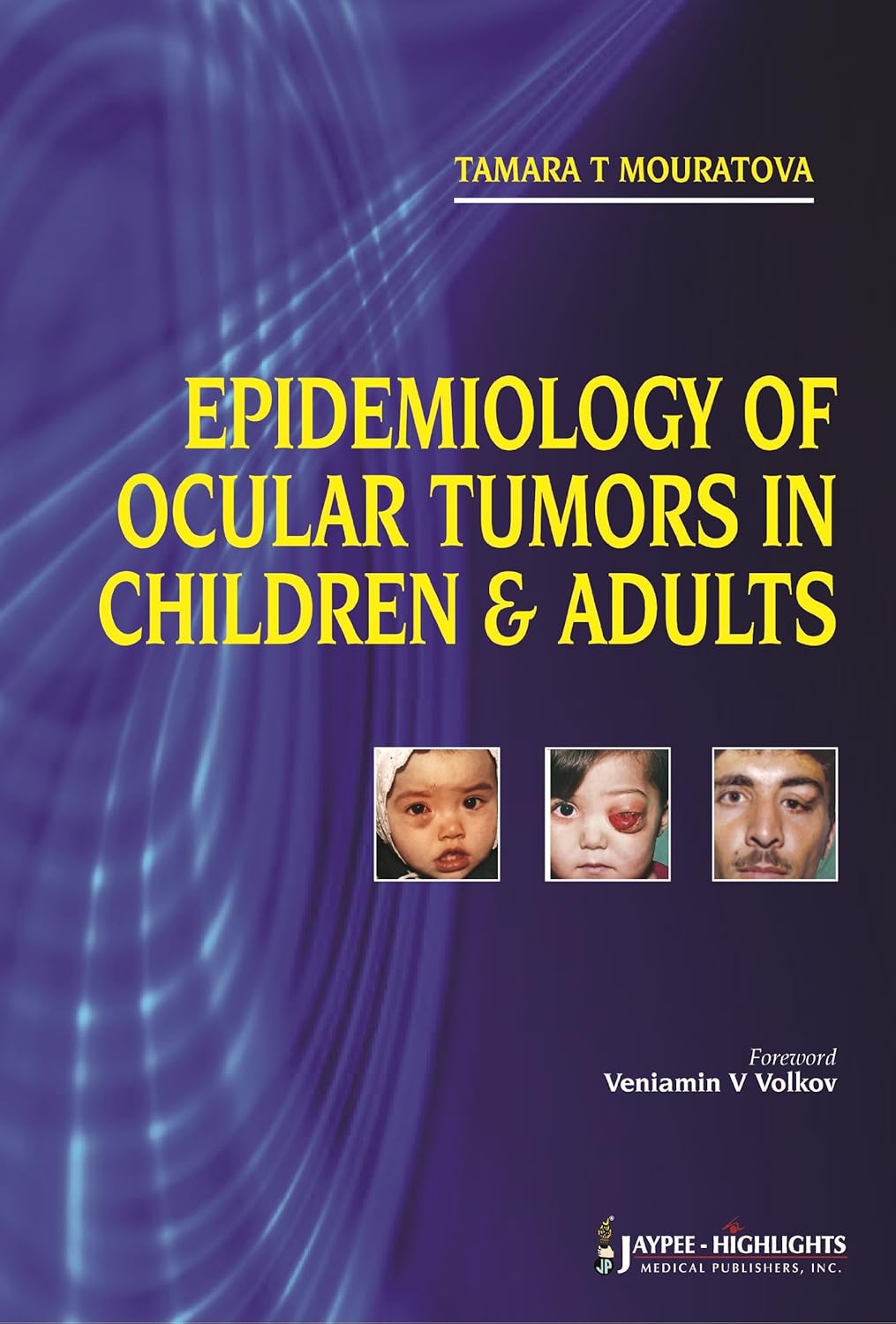 EPIDEMIOLOGY OF OCULAR TUMORS IN CHILDREN & ADULTS 1ST/2013 - TAMARA T MOURATOVA