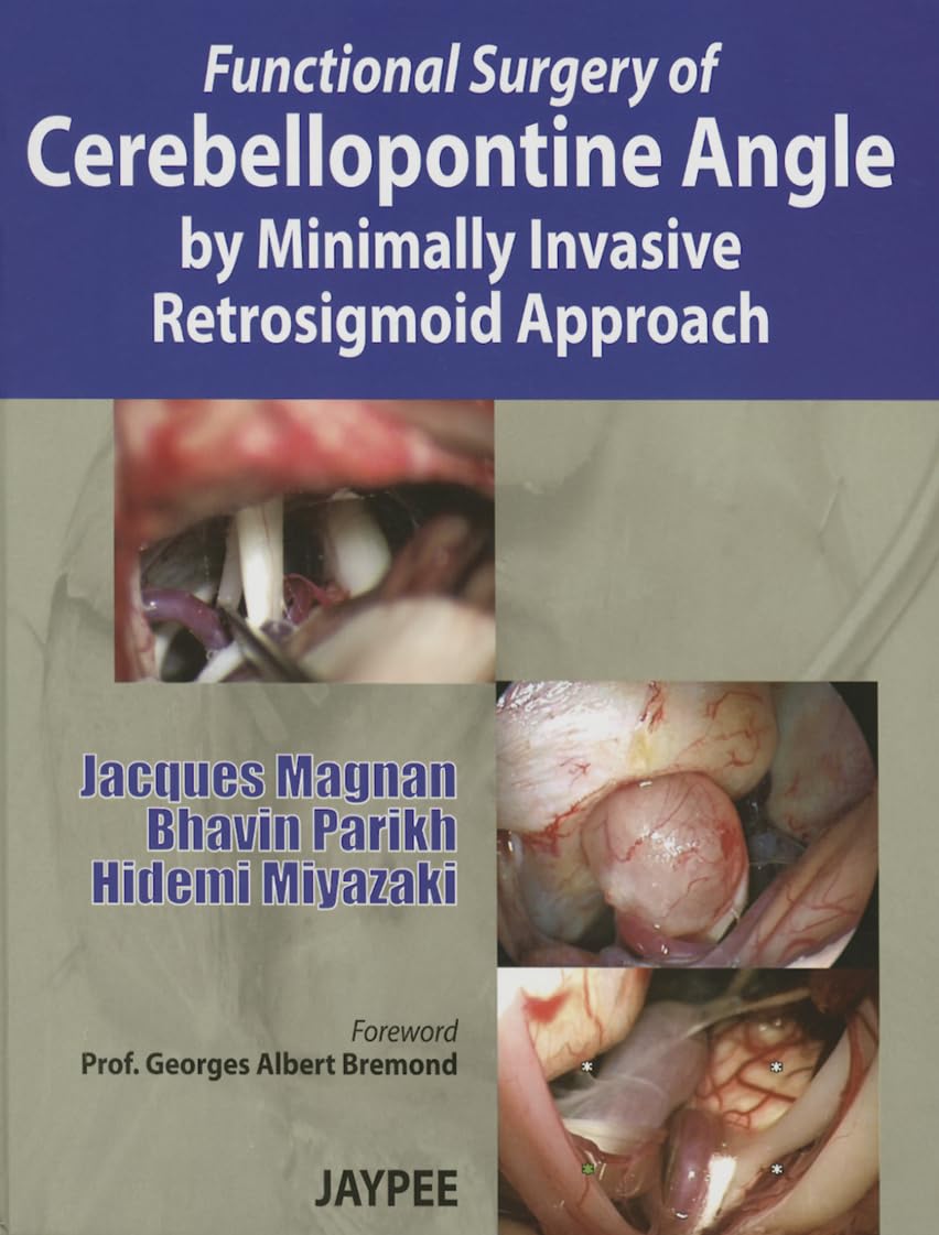FUNCTIONAL SURGERY OF CEREBELLOPONTINE ANGLE BY MINIMALLY INVASIVE RETROSIGMOID APPROACH 1ST/2013 - JACQUES PARIKH MAGNAN