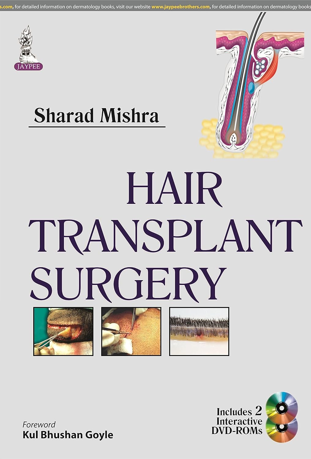 HAIR TRANSPLANT SURGERY 1ST/2014 - SHARAD MISHRA
