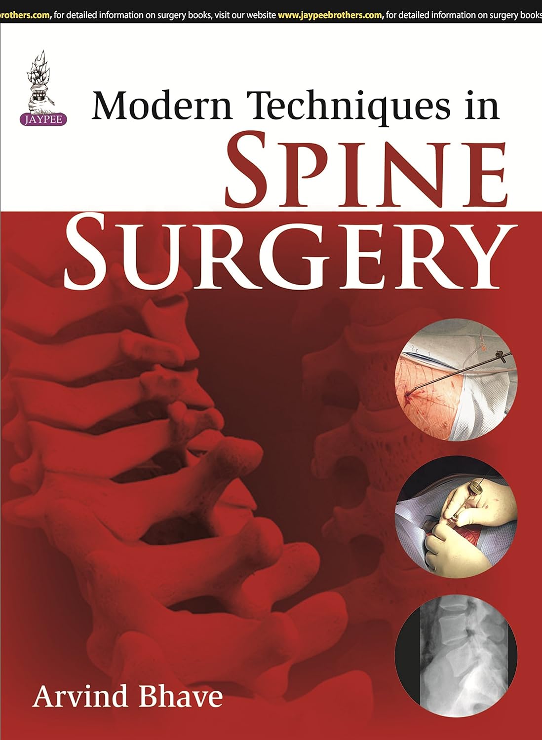 MODERN TECHNIQUES IN SPINE SURGERY WITH DVD-ROM 1ST/2015 - ARVIND BHAVE