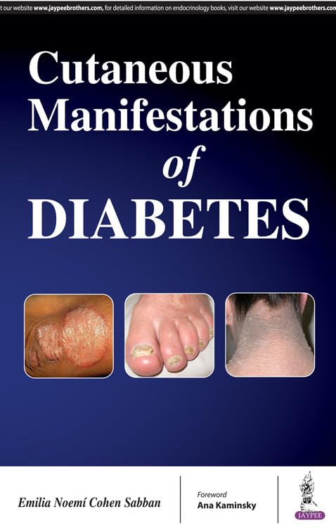 CUTANEOUS MANIFESTATIONS OF DIABETIES 1ST/2017 - EMILIA NOEMI COHEN SABBAN