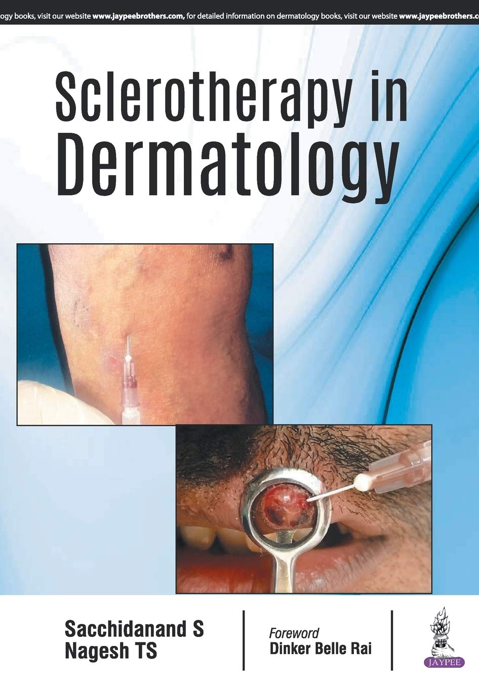 SCLEROTHERAPY IN DERMATOLOGY 1ST/2018 - SACCHIDANAND NAGESH TS