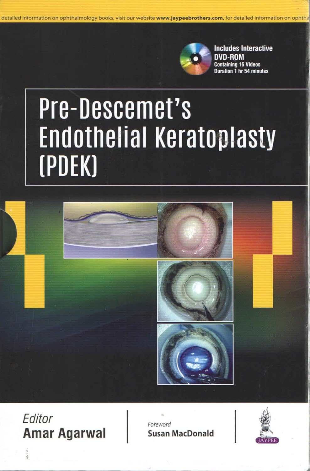 PRE-DESCEMET'S ENDOTHELIAL KERATOPLASTY(PDEK) 1ST/2018 - AMAR AGARWAL