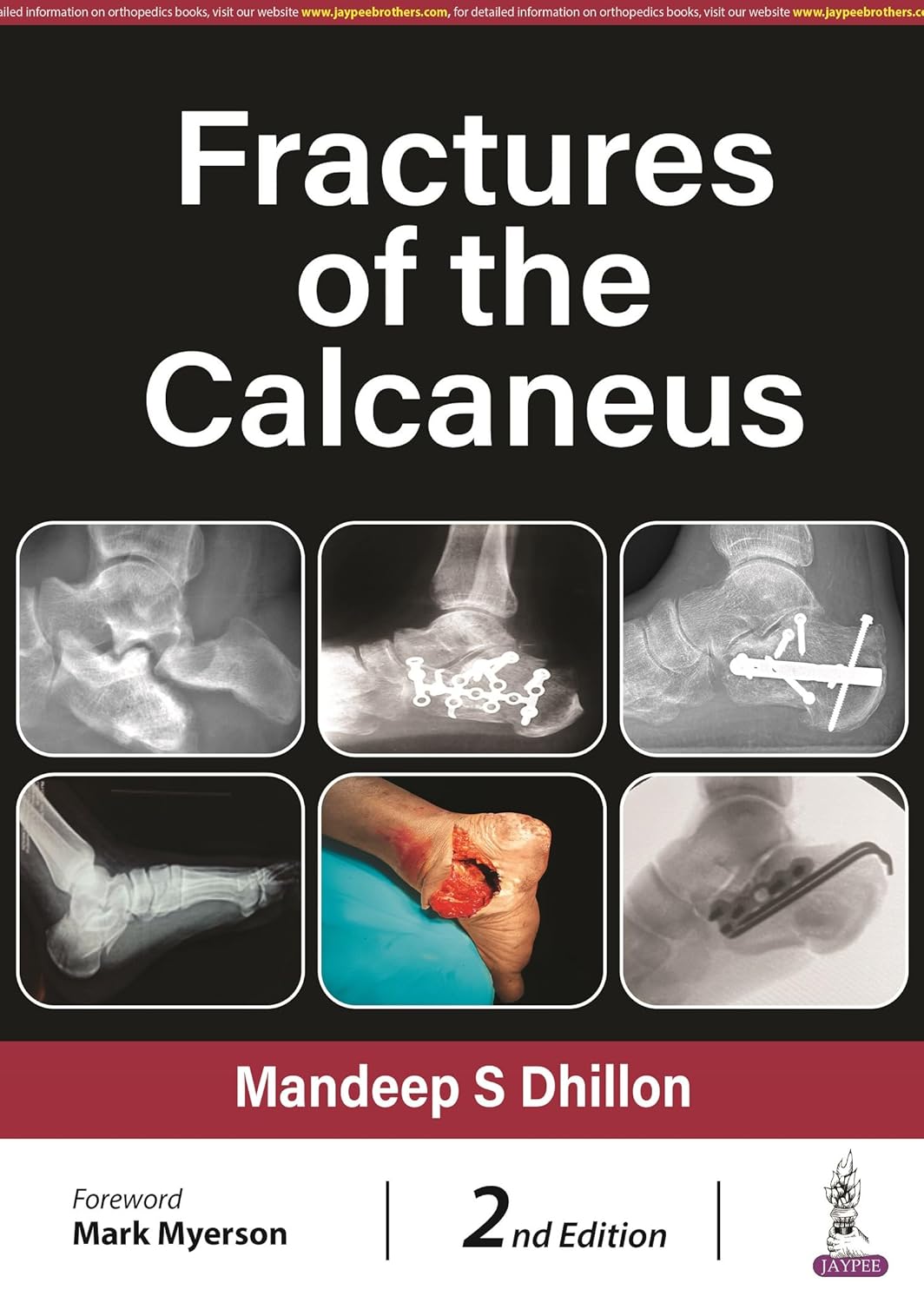 FRACTURES OF THE CALCANEUS 2ND/2024 - MANDEEP S DHILLON