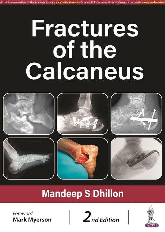FRACTURES OF THE CALCANEUS 2ND/2024 - MANDEEP S DHILLON