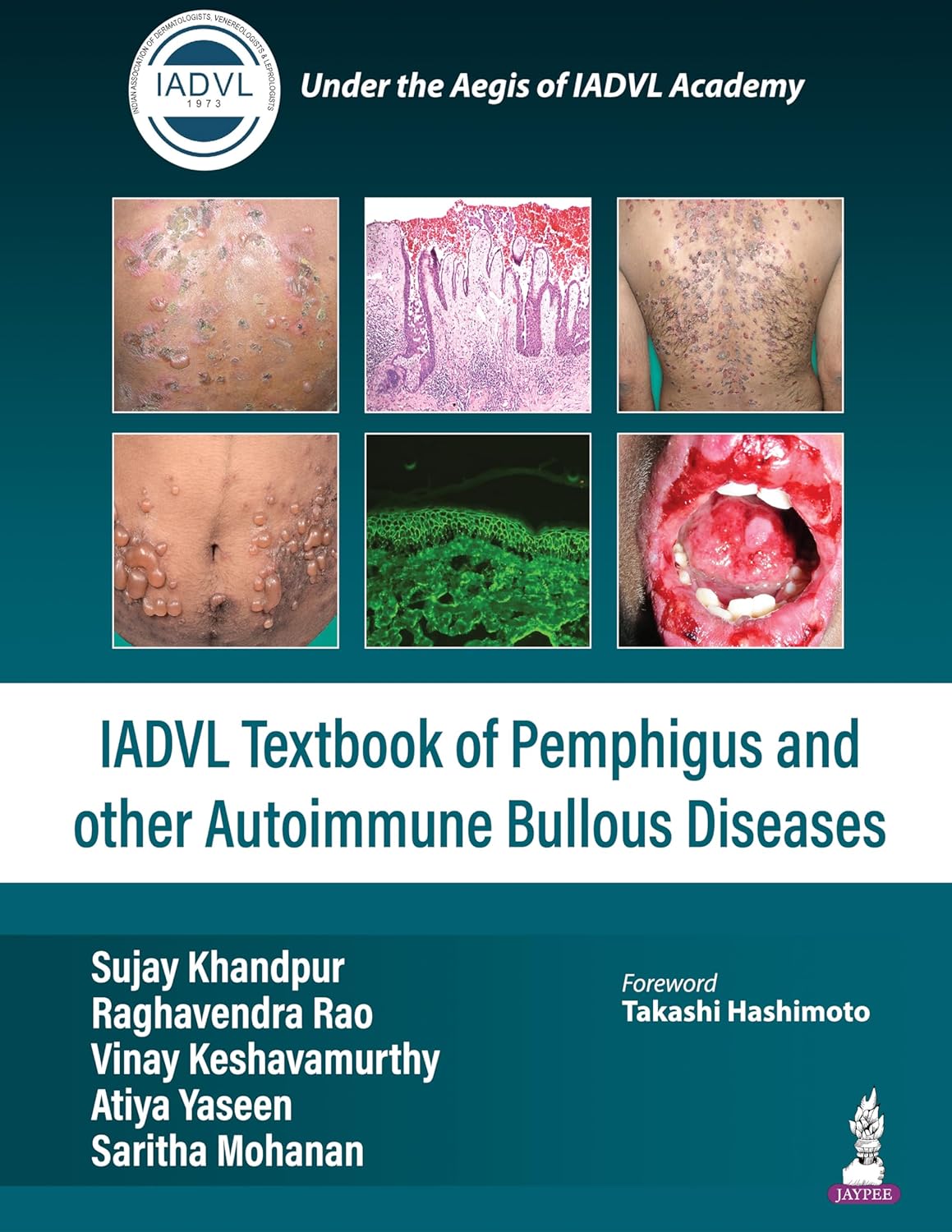 IADVL TEXTBOOK OF PEMPHIGUS AND OTHER AUTOIMMUNE BULLOUS DISEASES 1ST/2024 - SUJAY KHANDPUR