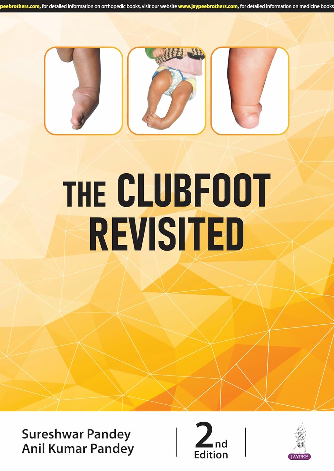 THE CLUBFOOT REVISITED 2ND/2025 - SURESHWAR PANDEY