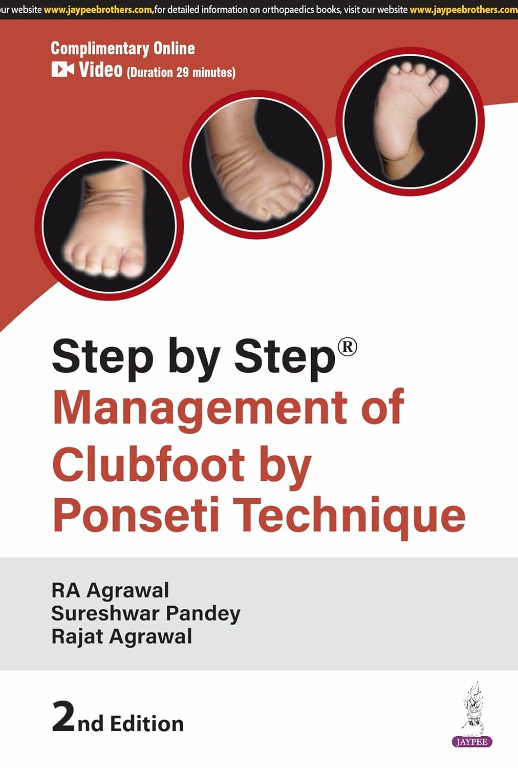 STEP BY STEP MANAGEMENT OF CLUBFOOT BY PONSETI TECHNIQUE 2ND/2025 - RA AGRAWAL