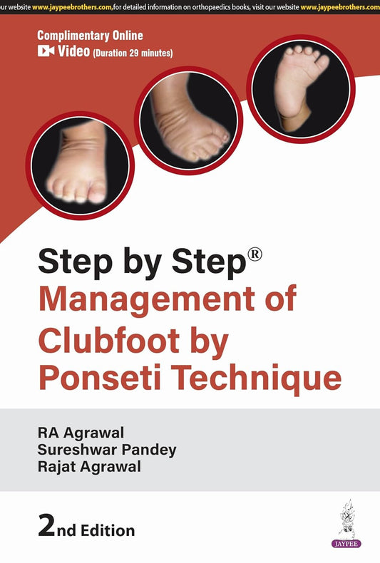 STEP BY STEP MANAGEMENT OF CLUBFOOT BY PONSETI TECHNIQUE 2ND/2025 - RA AGRAWAL