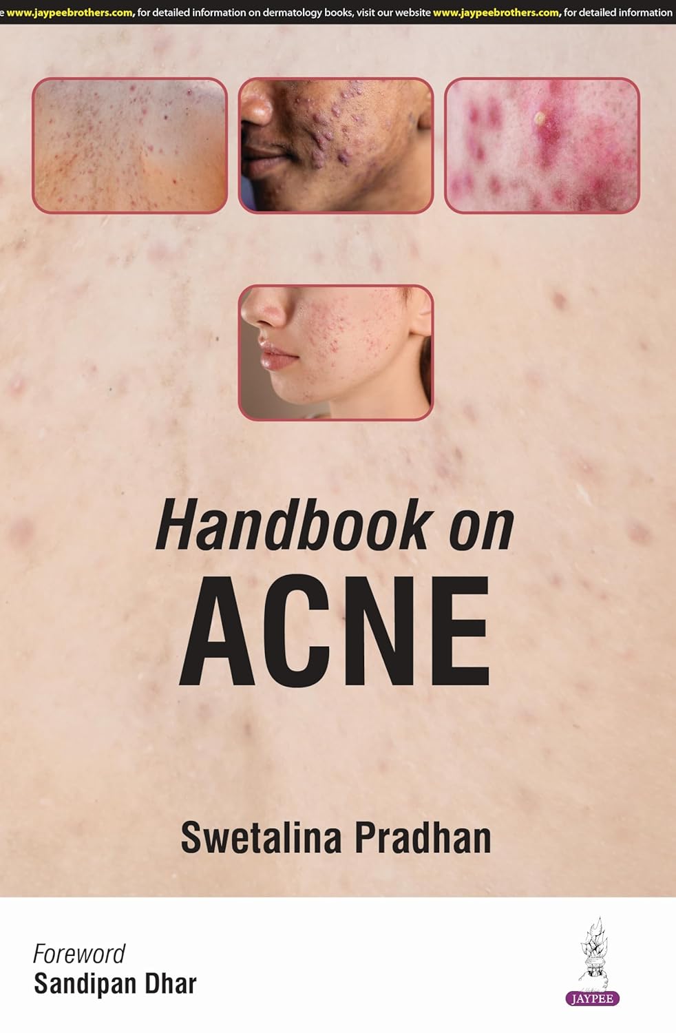 HANDBOOK ON ACNE 1ST/2025 - SWETALINA PRADHAN