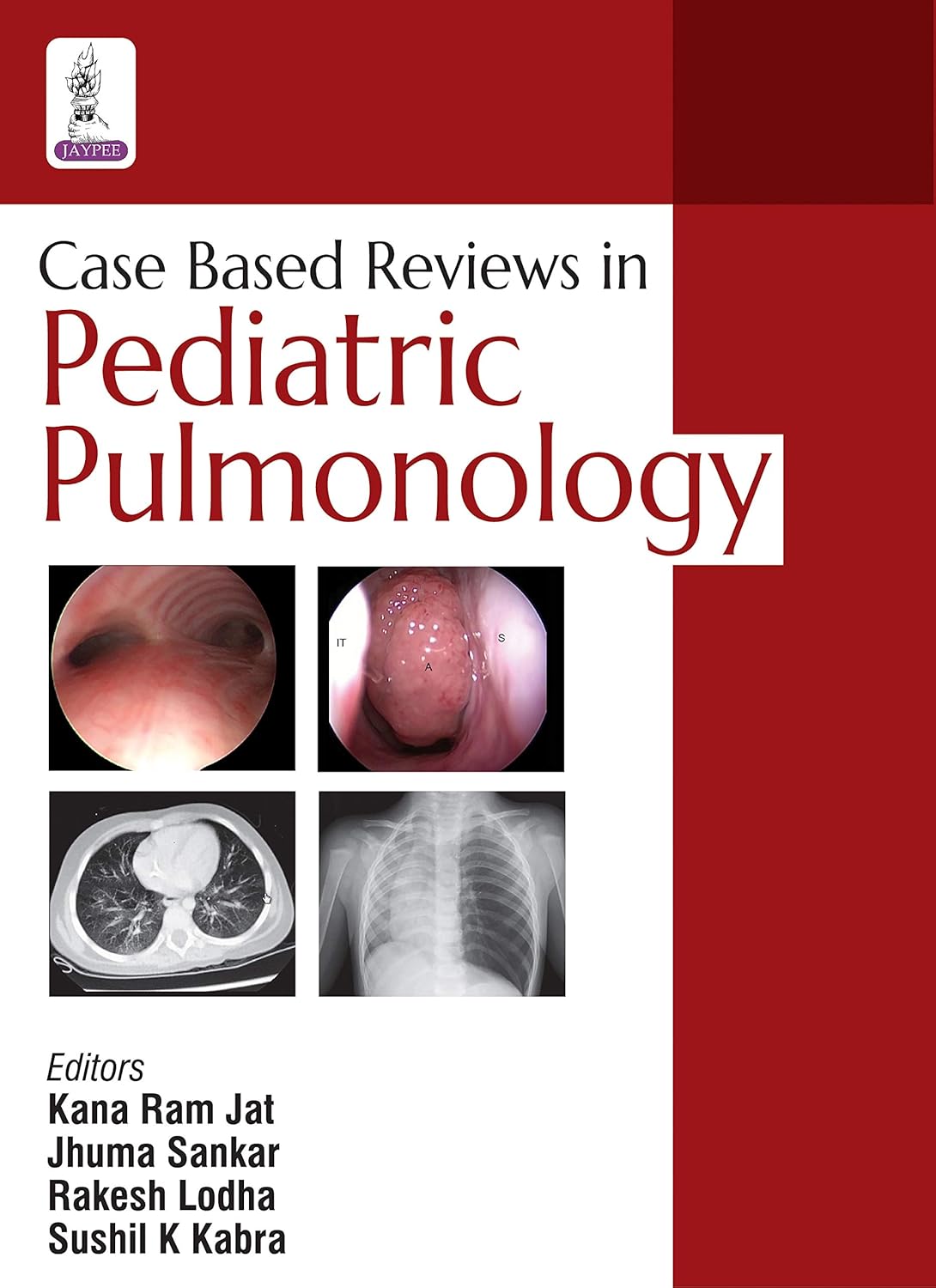 CASE BASED REVIEW IN PEDIATRIC PULMONOLOGY 1ST/2017 - KANA RAM JAT