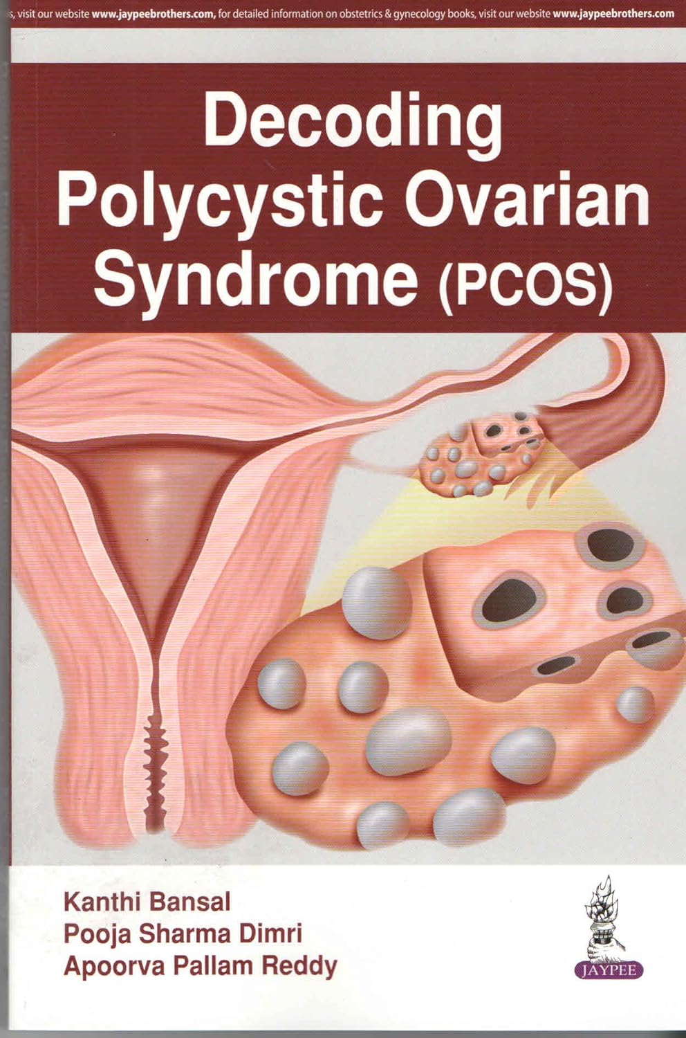 DECODING POLYCYSTIC OVARIAN SYNDROME (PCOS) 1ST/2017 - KANTHI BANSAL